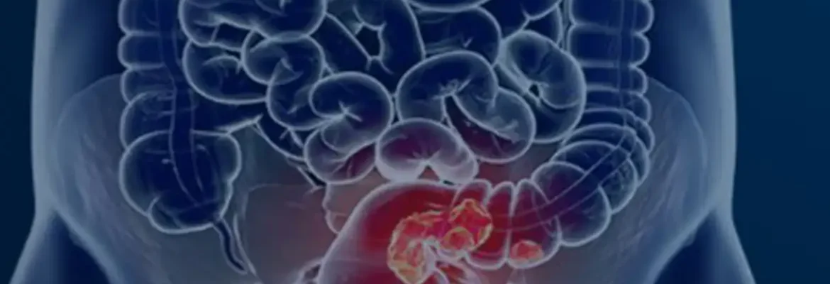 Pacientes com câncer colorretal são diagnosticados em estágio avançado