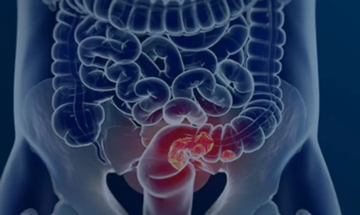 OAB Barro Preto - Pacientes com câncer colorretal são diagnosticados em estágio avançado