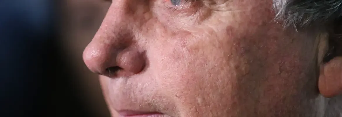 Com crise persistente de soluços, Bolsonaro faz nova cirurgia