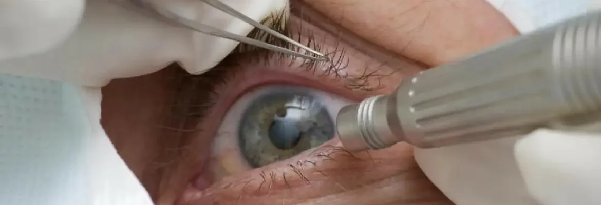 Lula faz cirurgia de catarata; entenda a doença e o procedimento