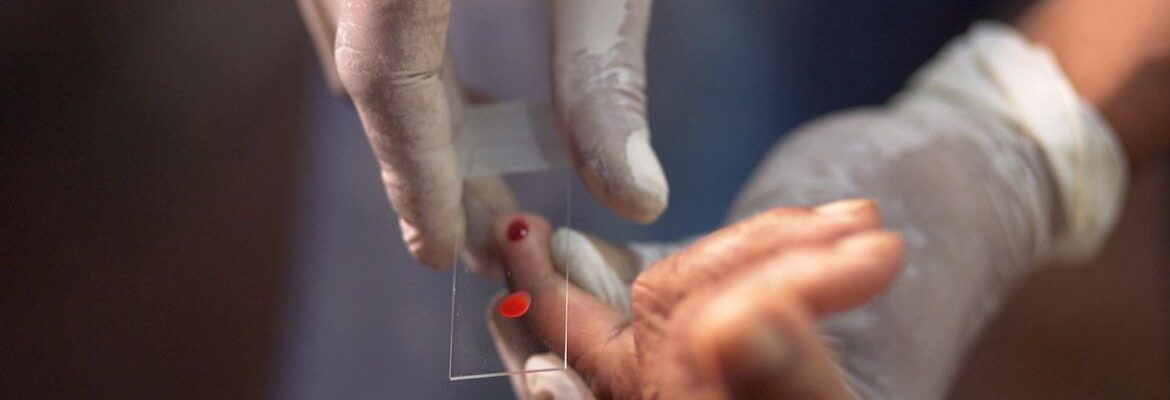 SUS começa a usar novo tratamento contra a malária em crianças